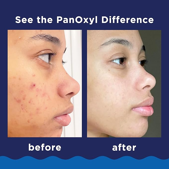 PanOxyl Acne Foaming Wash